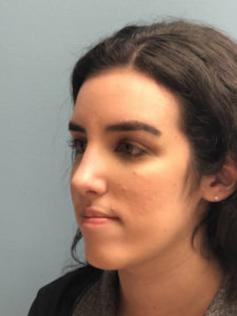 Primary Rhinoplasty Before & After Gallery - Patient 173090 - Image 6