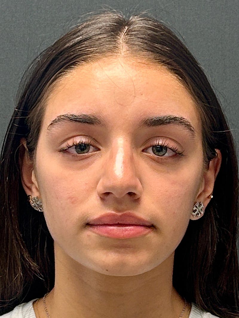 Primary Rhinoplasty Before & After Gallery - Patient 339573 - Image 3