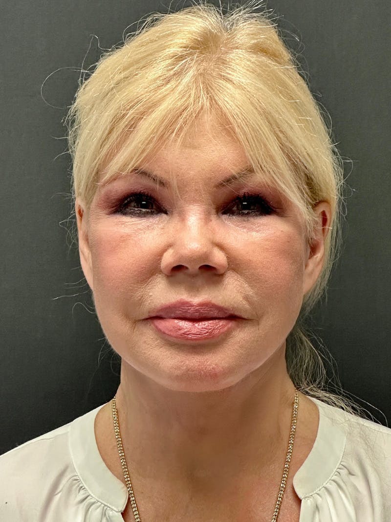 Facelift Before & After Gallery - Patient 112257 - Image 2