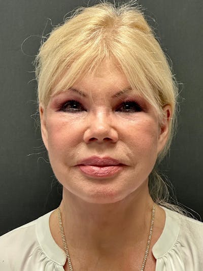 Facelift Before & After Gallery - Patient 112257 - Image 2