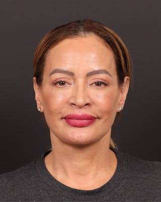 Facelift Before & After Gallery - Patient 310751 - Image 2