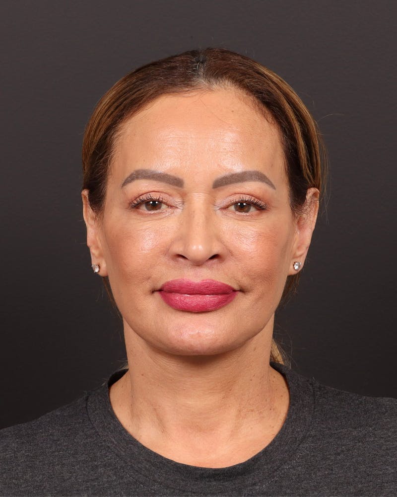 Facelift Before & After Gallery - Patient 310751 - Image 2