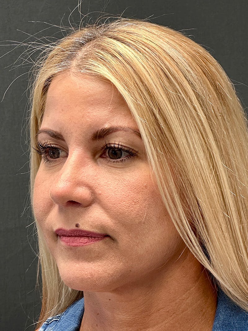 Primary Rhinoplasty Before & After Gallery - Patient 386694 - Image 6