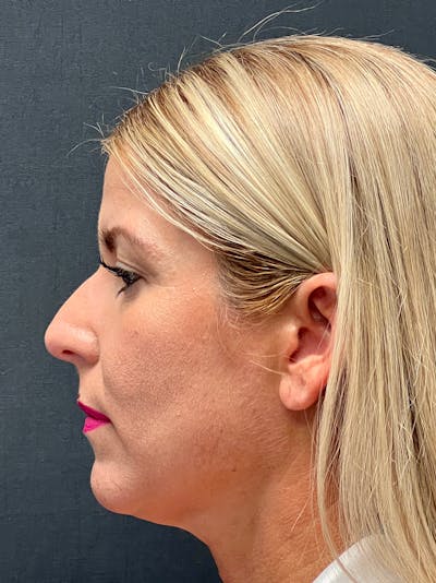 Primary Rhinoplasty Before & After Gallery - Patient 386694 - Image 1