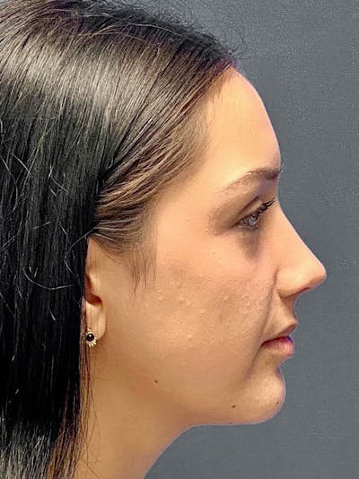 Primary Rhinoplasty Before & After Gallery - Patient 330004 - Image 2