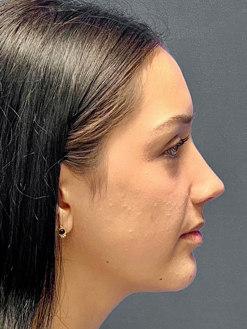 Primary Rhinoplasty Before & After Gallery - Patient 330004 - Image 2