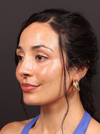 Primary Rhinoplasty Before & After Gallery - Patient 319902 - Image 8