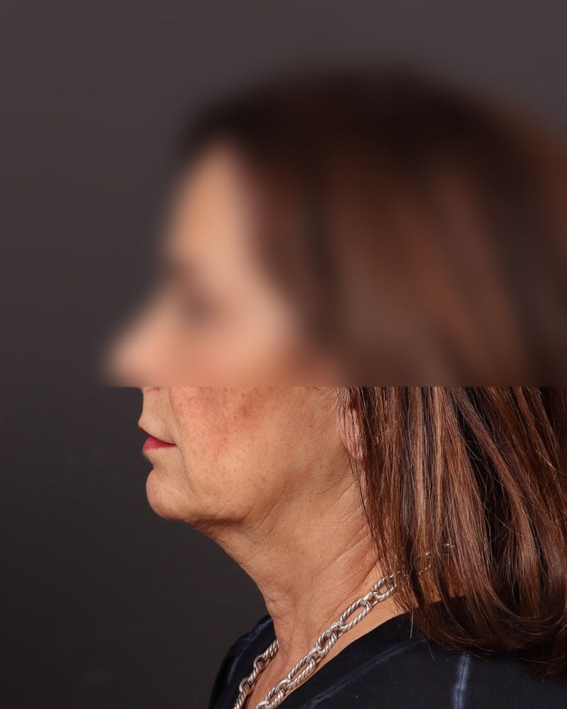 Facelift Before & After Gallery - Patient 706307 - Image 3