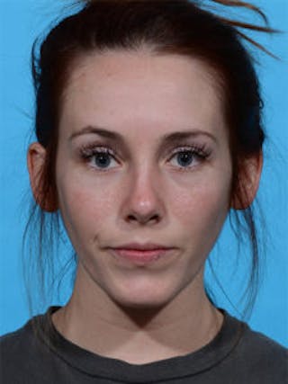 Primary Rhinoplasty Before & After Gallery - Patient 262137 - Image 4