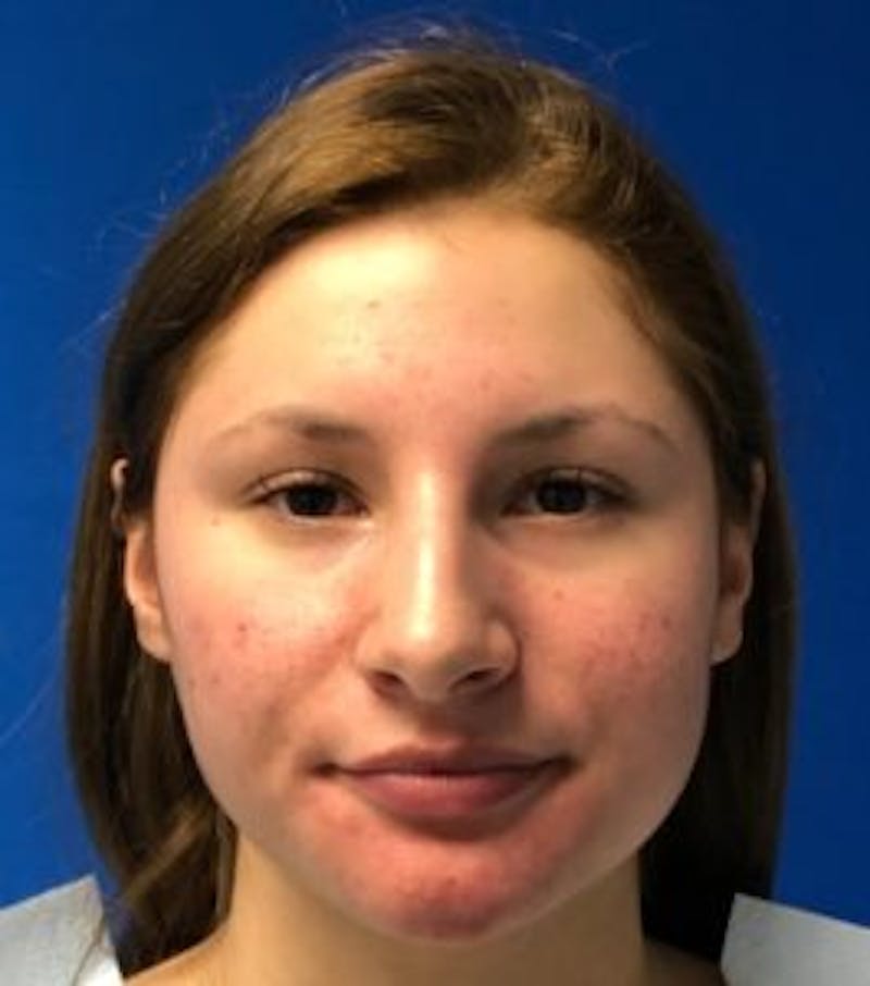 Primary Rhinoplasty Before & After Gallery - Patient 550195 - Image 5