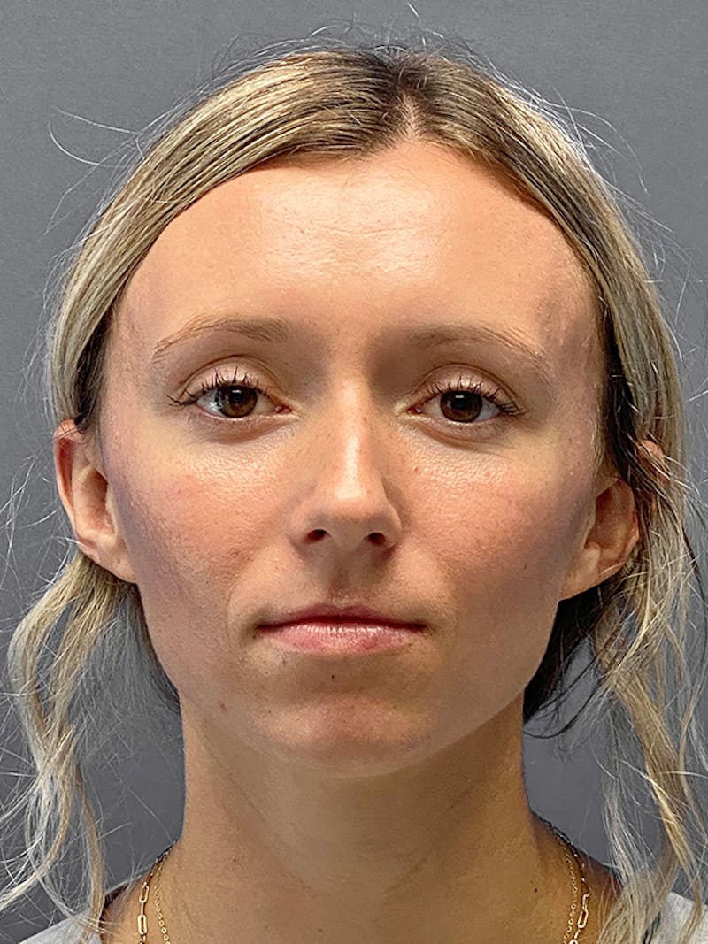 Chin Augmentation Before & After Gallery - Patient 142902 - Image 3