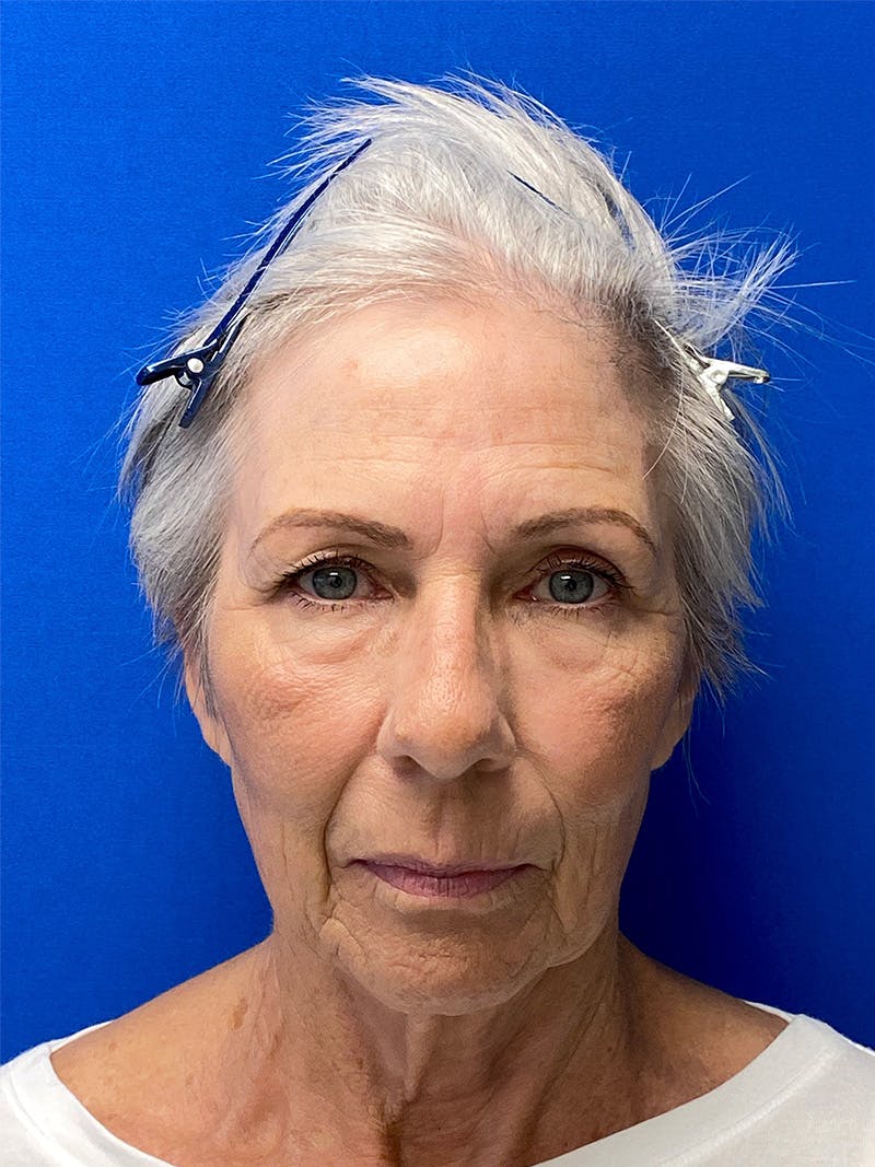 Facelift Before & After Gallery - Patient 349518 - Image 1