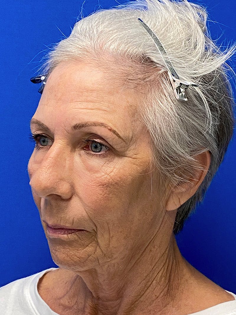 Facelift Before & After Gallery - Patient 349518 - Image 3