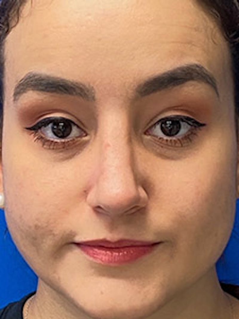 Primary Rhinoplasty Before & After Gallery - Patient 986682 - Image 4