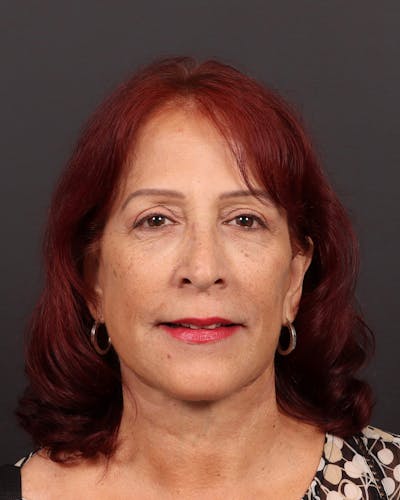 Facelift Before & After Gallery - Patient 171272 - Image 2