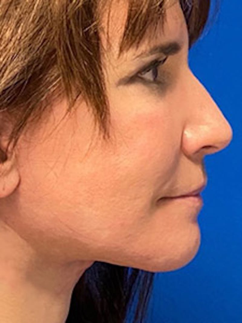 Facelift Before & After Gallery - Patient 327892 - Image 4