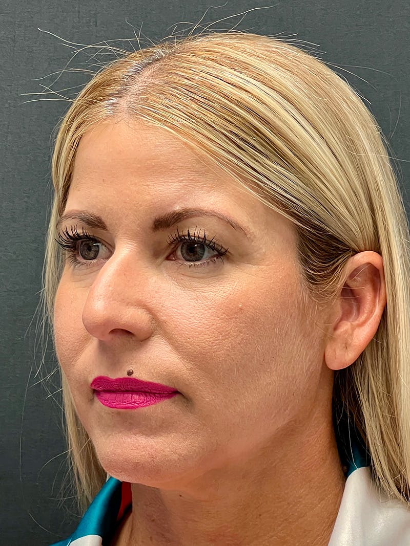 Primary Rhinoplasty Before & After Gallery - Patient 386694 - Image 5