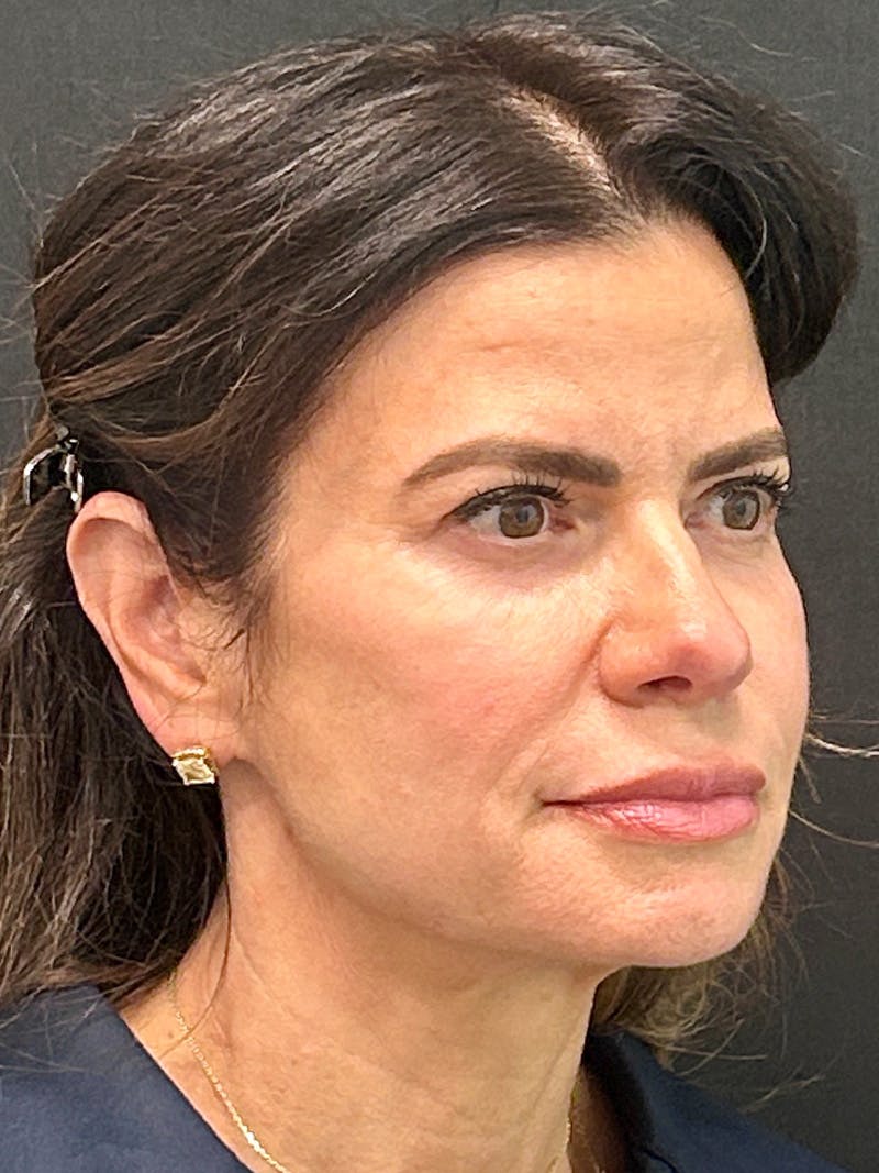 Brow Lift Before & After Gallery - Patient 387096 - Image 3