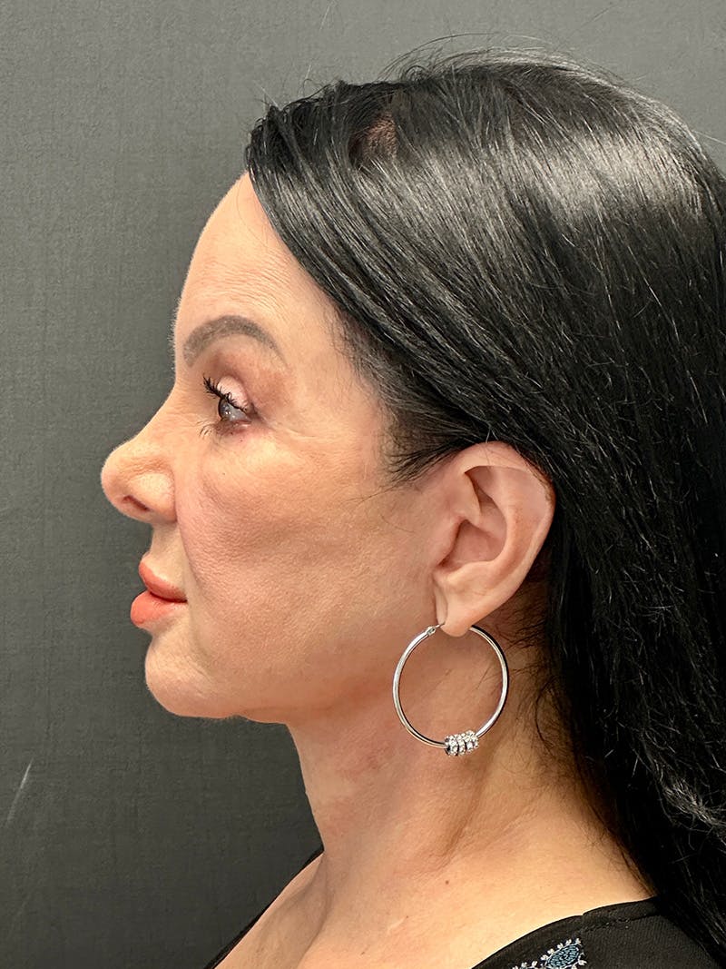 Blepharoplasty Before & After Gallery - Patient 409475 - Image 6
