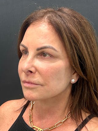 Brow Lift Before & After Gallery - Patient 349364 - Image 4