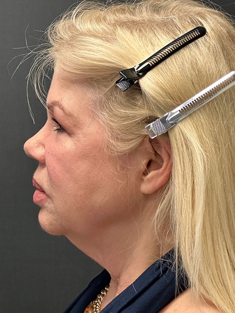Facelift Before & After Gallery - Patient 112257 - Image 5