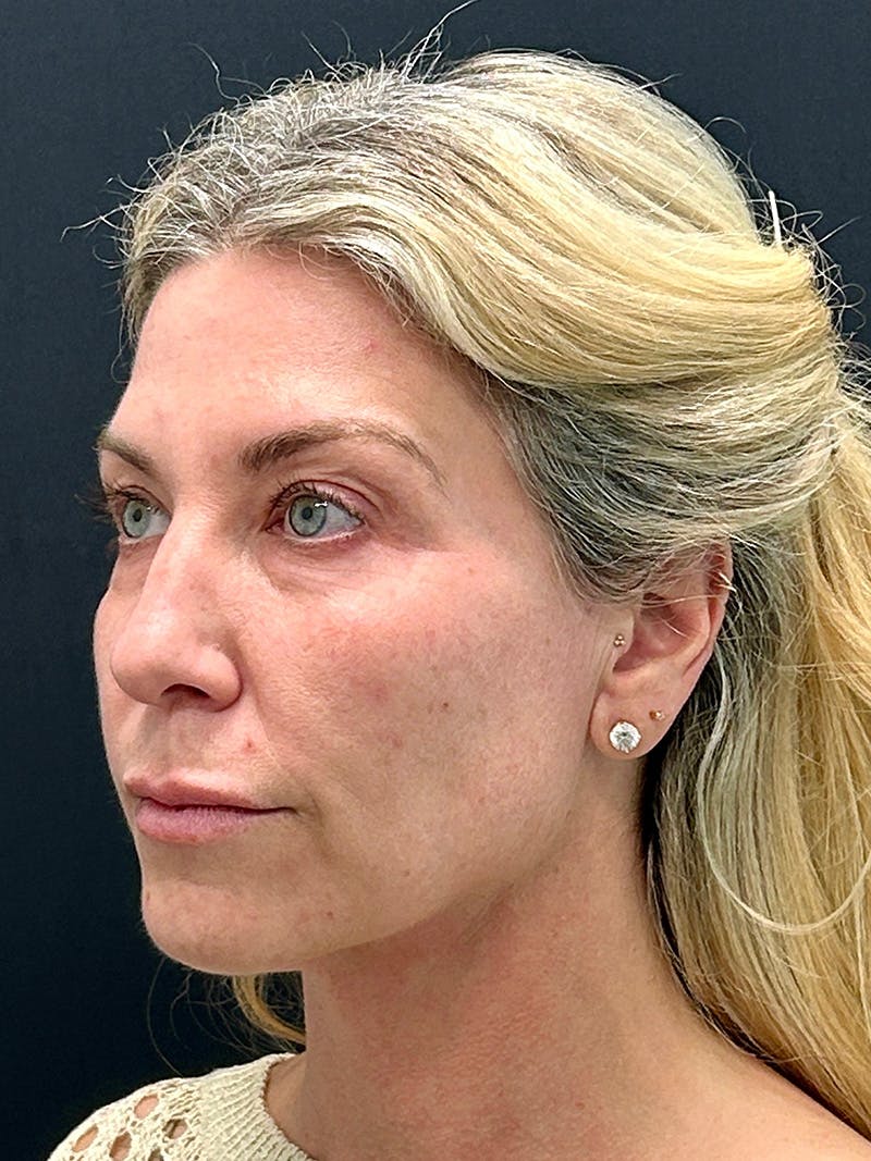 Facelift Before & After Gallery - Patient 420053 - Image 3