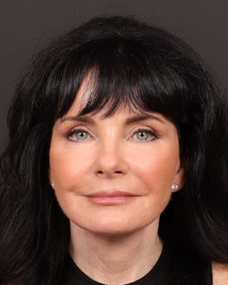 Facelift Before & After Gallery - Patient 285891 - Image 2
