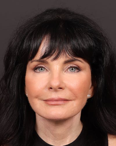 Facelift Before & After Gallery - Patient 285891 - Image 2