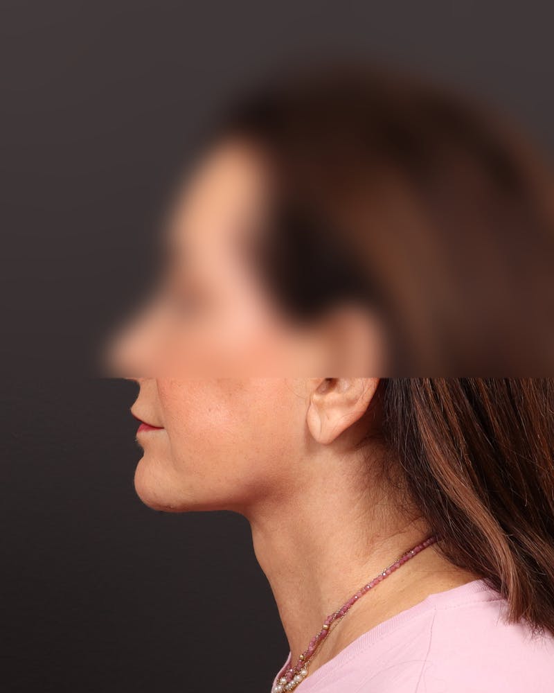 Facelift Before & After Gallery - Patient 706307 - Image 4