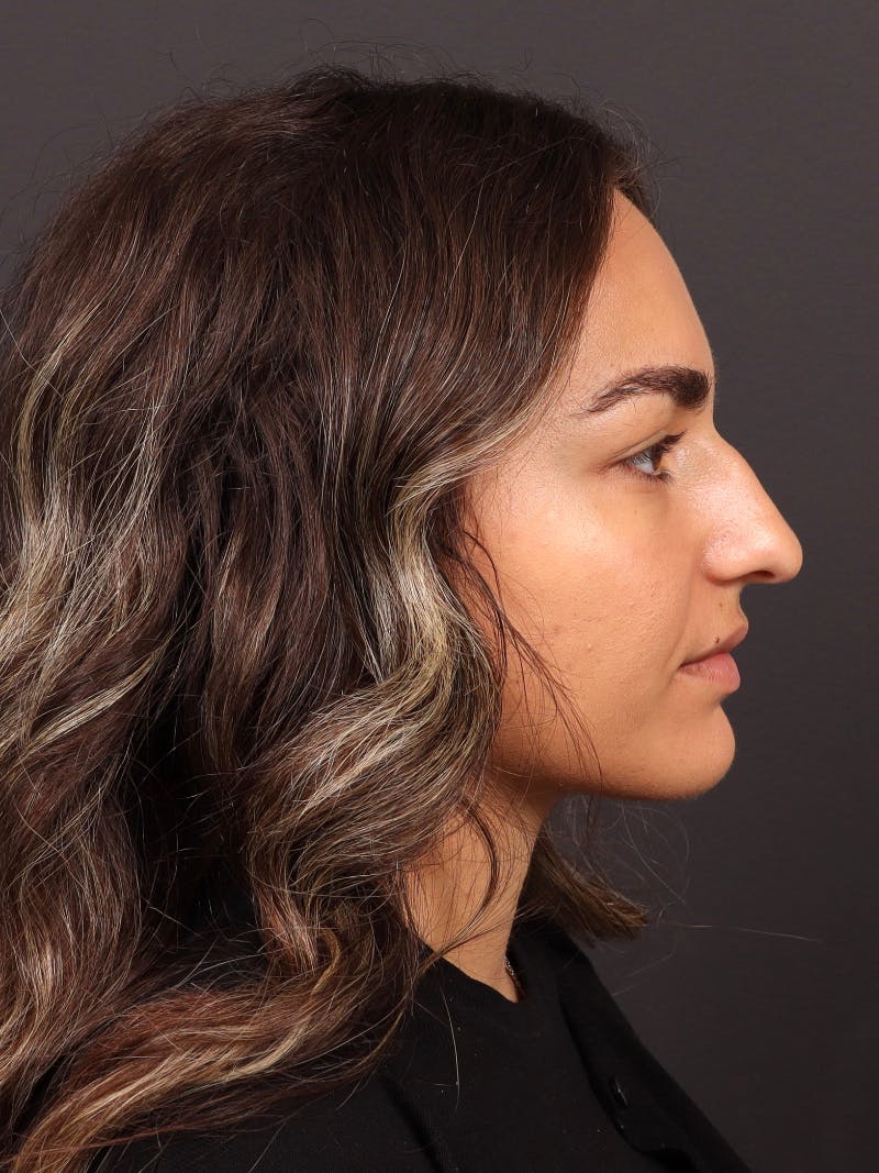 Primary Rhinoplasty Before & After Gallery - Patient 933905 - Image 1