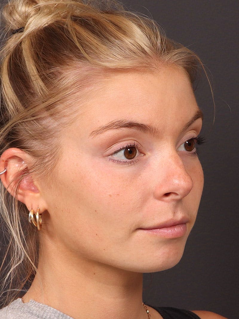 Primary Rhinoplasty Before & After Gallery - Patient 194014 - Image 5