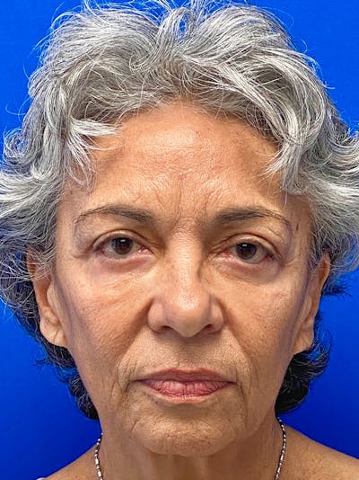 Facelift Before & After Gallery - Patient 748687 - Image 1