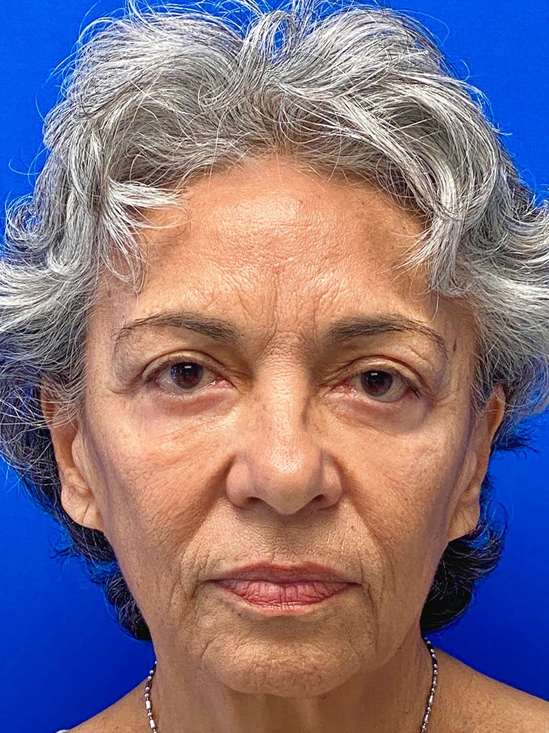 Facial Fat Grafting Before & After Gallery - Patient 411961 - Image 1