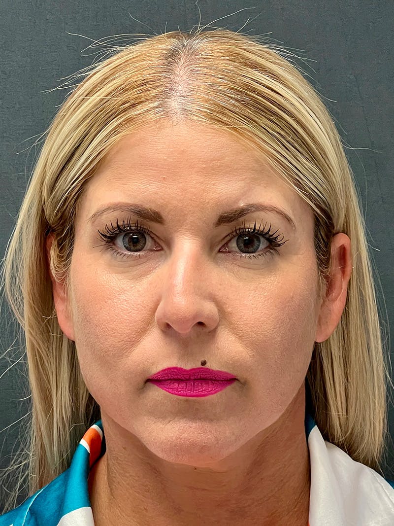 Primary Rhinoplasty Before & After Gallery - Patient 386694 - Image 3