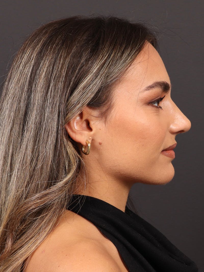 Primary Rhinoplasty Before & After Gallery - Patient 933905 - Image 2