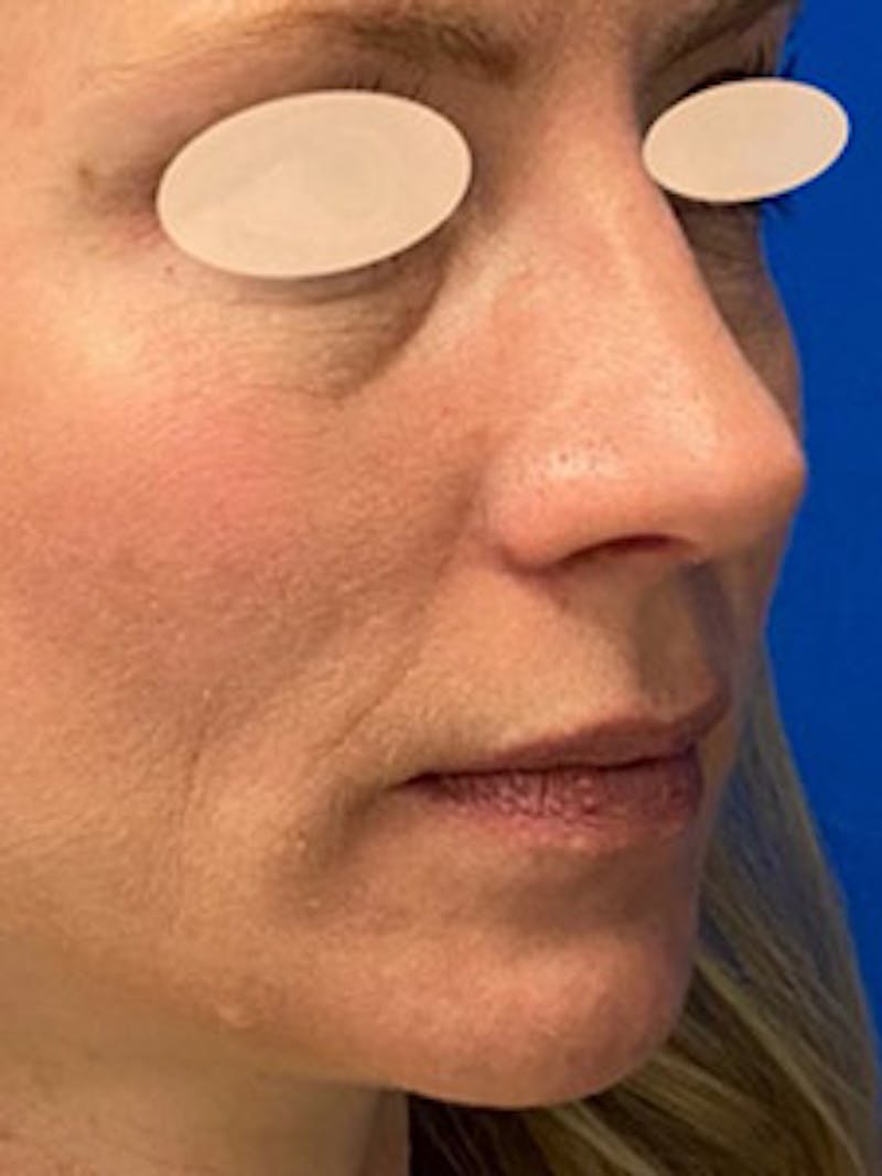 Primary Rhinoplasty Before & After Gallery - Patient 305892 - Image 8