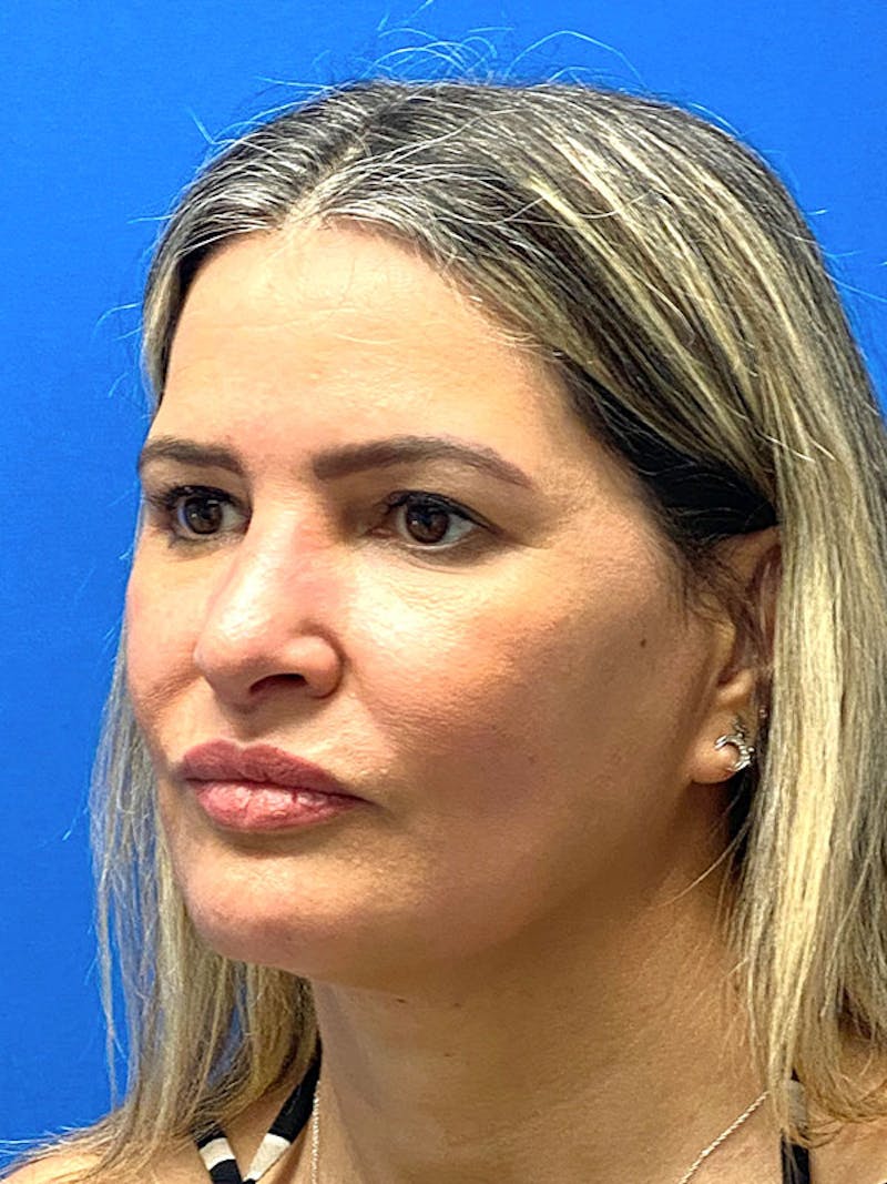 Revision Rhinoplasty Before & After Gallery - Patient 283261 - Image 5