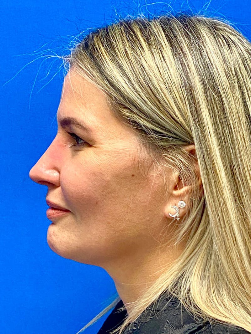 Revision Rhinoplasty Before & After Gallery - Patient 283261 - Image 2