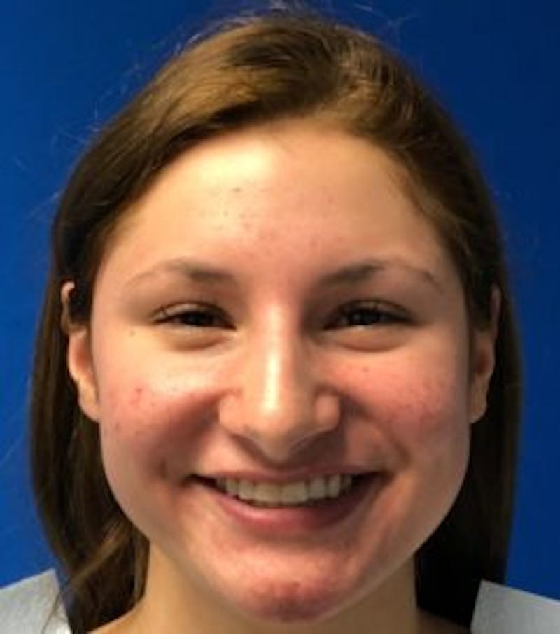 Primary Rhinoplasty Before & After Gallery - Patient 550195 - Image 3