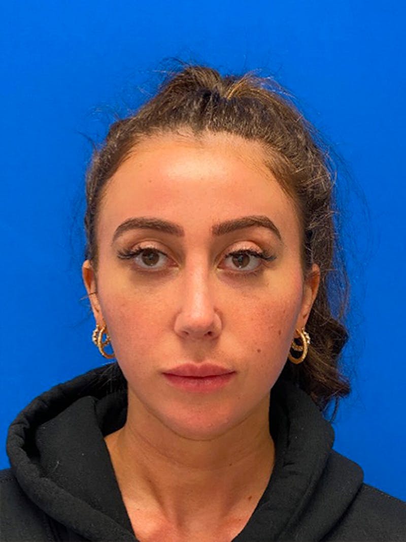 Primary Rhinoplasty Before & After Gallery - Patient 334537 - Image 4
