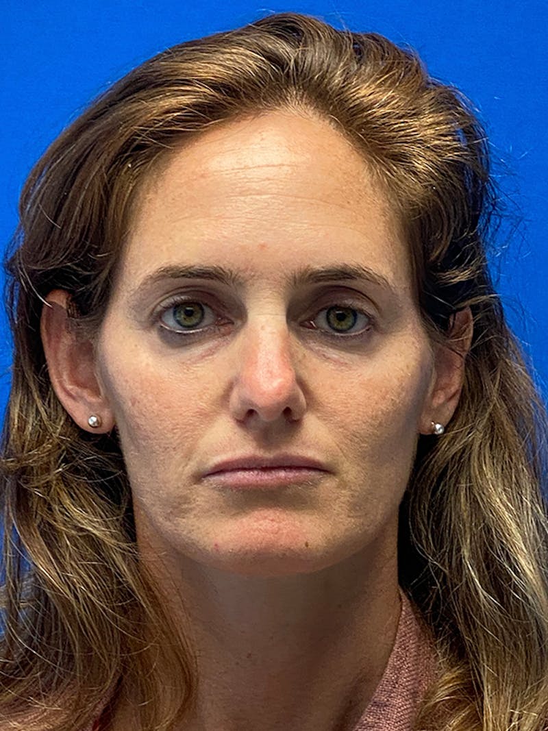 Revision Rhinoplasty Before & After Gallery - Patient 330413 - Image 3