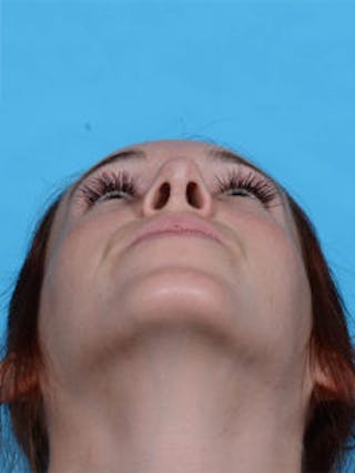 Primary Rhinoplasty Before & After Gallery - Patient 262137 - Image 6