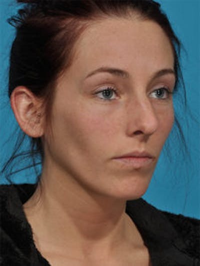 Primary Rhinoplasty Before & After Gallery - Patient 262137 - Image 1