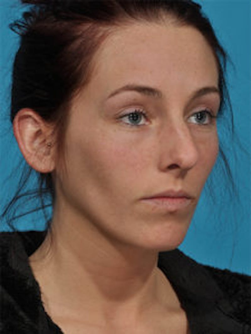 Primary Rhinoplasty Before & After Gallery - Patient 262137 - Image 1
