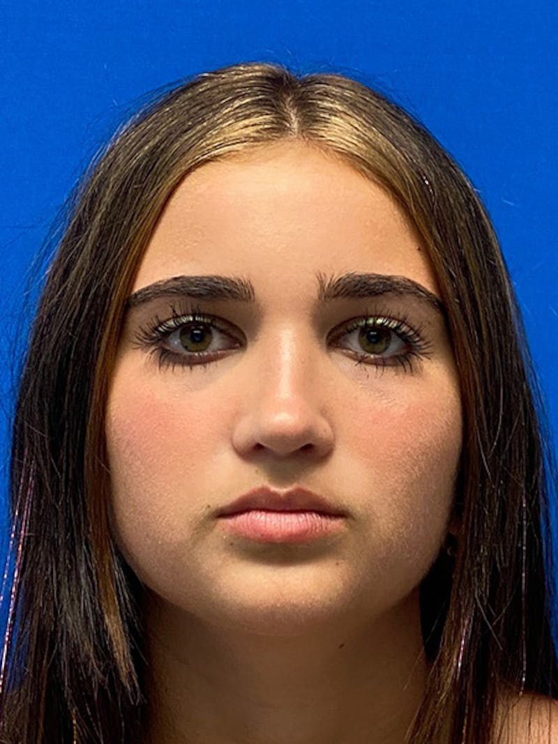 Primary Rhinoplasty Before & After Gallery - Patient 401318 - Image 4