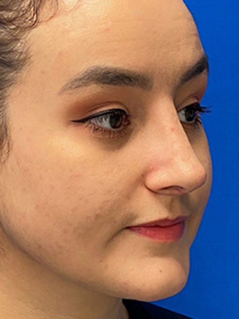 Primary Rhinoplasty Before & After Gallery - Patient 986682 - Image 8