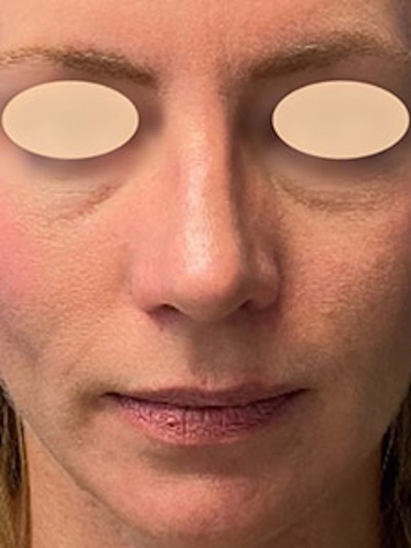 Primary Rhinoplasty Before & After Gallery - Patient 305892 - Image 4