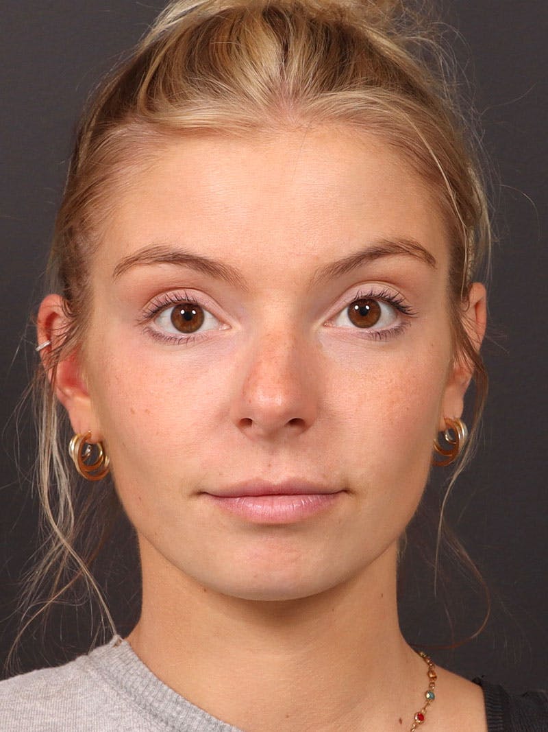 Primary Rhinoplasty Before & After Gallery - Patient 194014 - Image 3