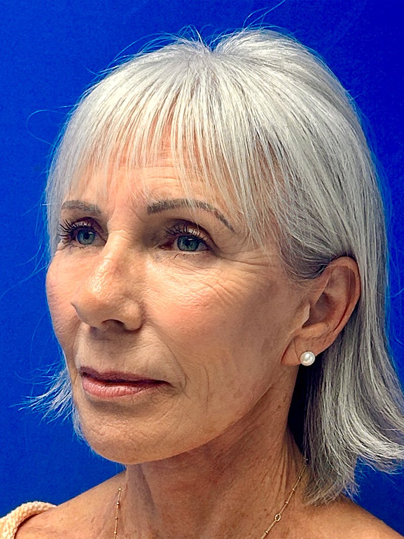 Facelift Before & After Gallery - Patient 349518 - Image 4