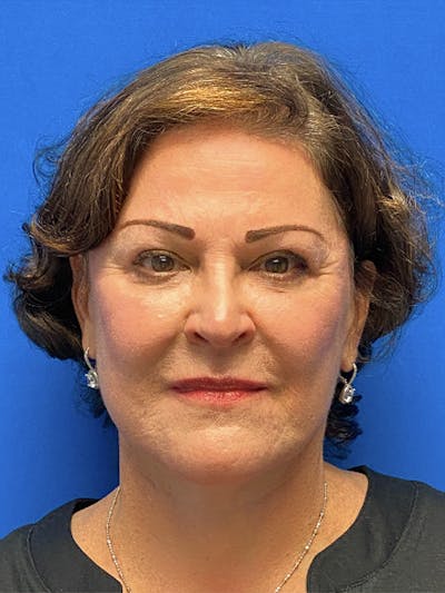 Facelift Before & After Gallery - Patient 181164 - Image 2